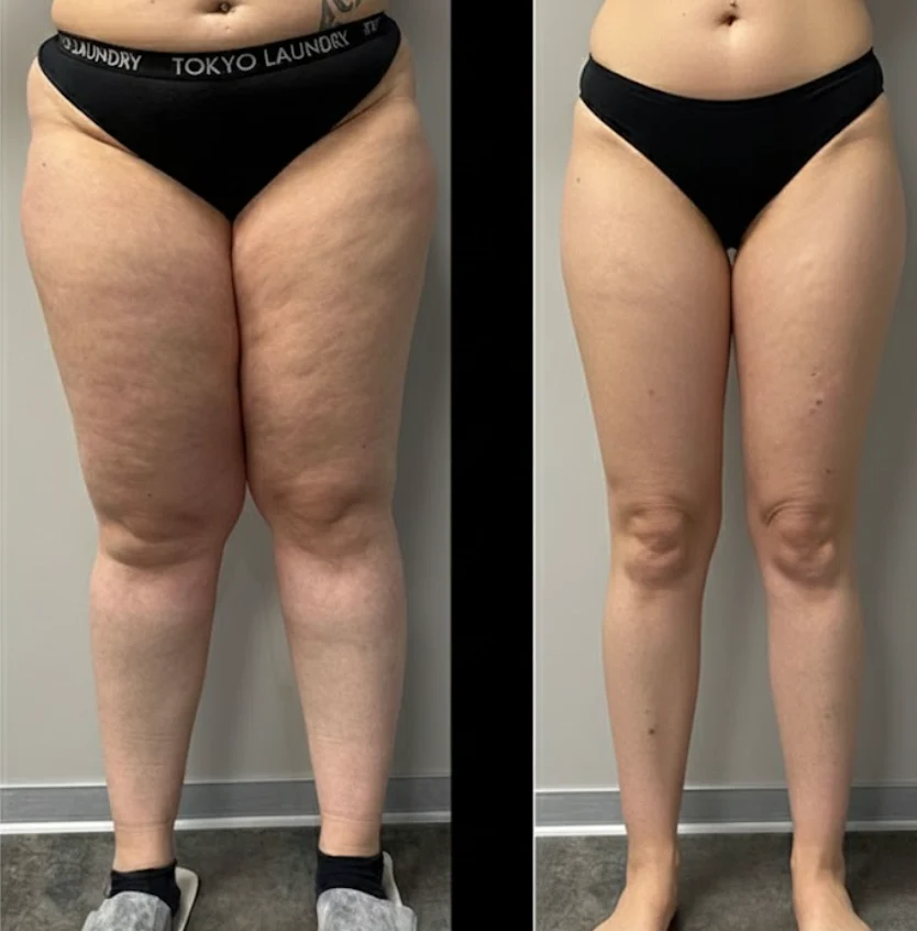 LIPEDEMA