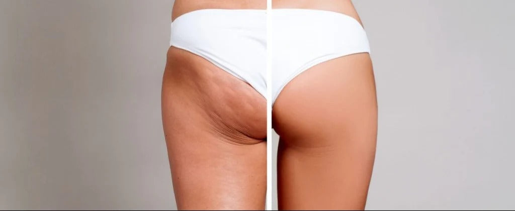 CELLULITE