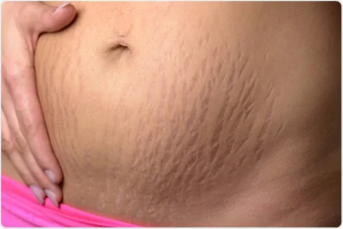 STRETCH MARKS